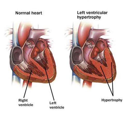 » Cardiomegaly – Causes, Treatment, Symptoms, Pictures, Types