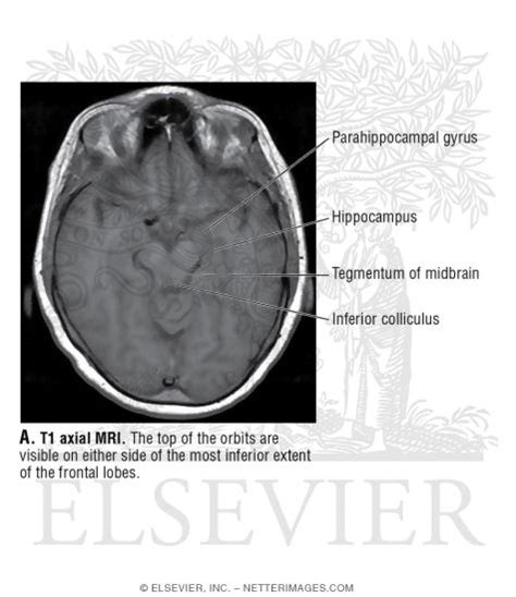 T1 Axial MRI Through the Optic Chiasm