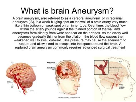 Brain aneurysm coiling