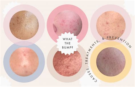 A Complete Guide to Clearing the Different Types of Clogged Pores