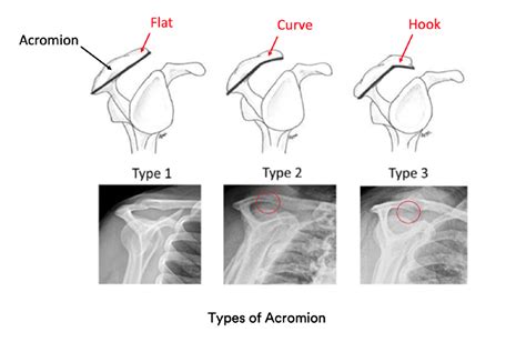 Shoulder Spurs | Dr Pant - Sydney Shoulder Unit