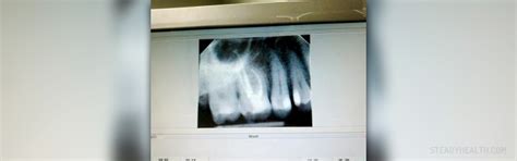 Root canal complications | General center | SteadyHealth.com