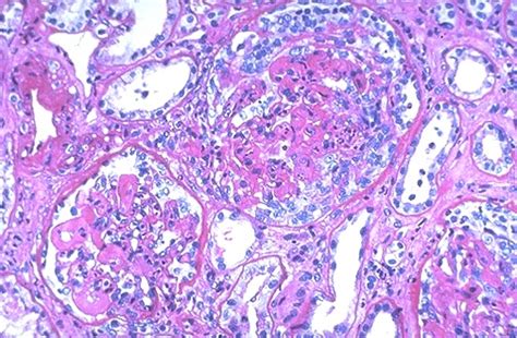 Renal Pathology