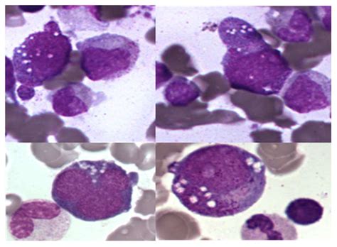 Diagnostics | Free Full-Text | VEXAS Syndrome: A Novelty in MDS Landscape