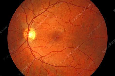 Healthy eye, fundus image - Stock Image C026/1050 - Science Photo Library