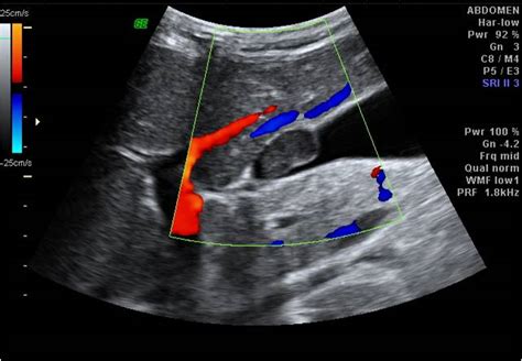 Gall Bladder Wall Cyst [ Possibly Submucous Cyst ]: An Ultrasound Diagnosis - Sumer's Radiology Blog