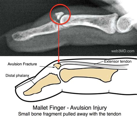 mallet-finger-avulsion-fracture