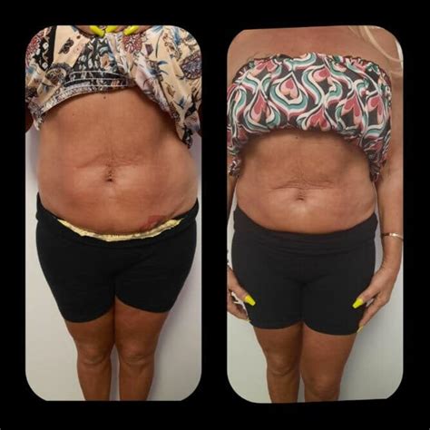 #1 Lipo Laser Therapy in Pinellas County | Flawless Lipo Laser