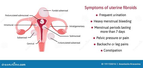 Uterine Fibroids and Its Symptoms. List of Symptoms. Different Locations Inside Womb Subserosal ...