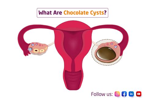 Ovarian Endometriomas: What Are Chocolate Cysts?