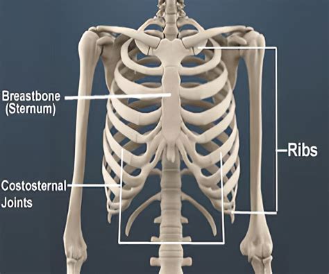 Costochondritis Symptoms Causes Treatment And Picture - vrogue.co