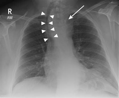 An abnormal chest radiograph | The BMJ