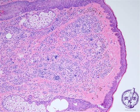 Junctional Nevus