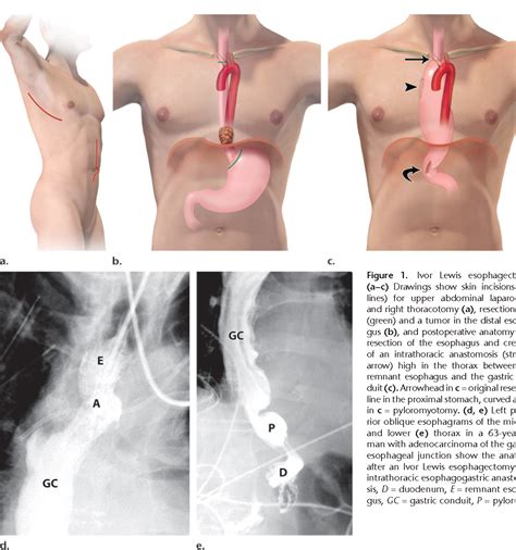 Esophagectomy and Gastric Pull-through Procedures: Surgical Techniques ...