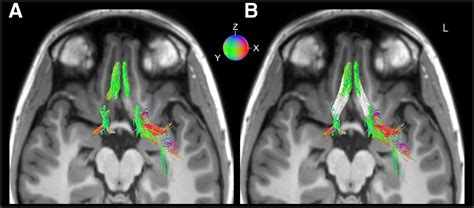 Olfactory Nerve Mri