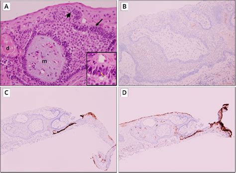 Histopathology of Bulbar Conjunctival Lesion A, Histology demonstrates... | Download Scientific ...