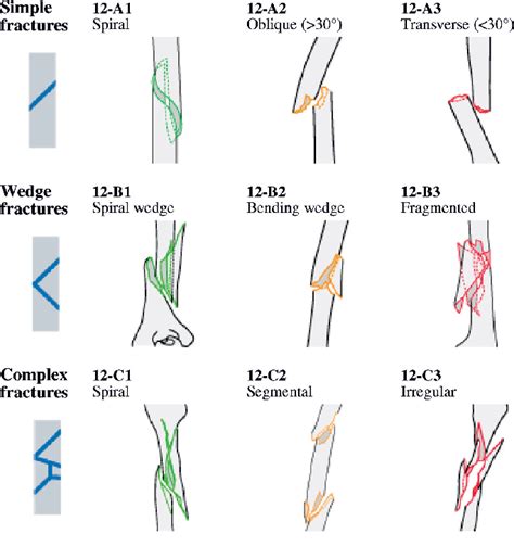 Figure 1 from humerus shaft fractures where are we today semantic scholar – Artofit