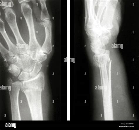 Colles Fracture X Ray