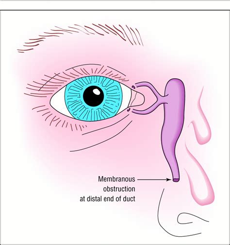 Fortnightly review: Managing congenital lacrimal obstruction in general ...