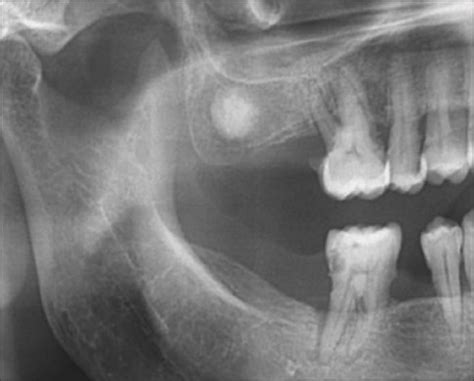 Radiological view of odontoma in the maxillary molar ar | Open-i