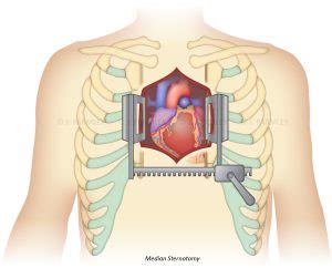 Median Sternotomy – Jessica Parmley