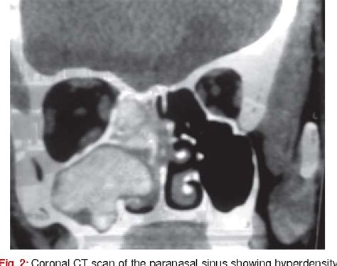 Figure 2 from Paranasal Sinuses Fungal Balls in Children | Semantic Scholar