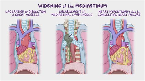 Mediastinum Anatomy Anatomy Drawing Diagram