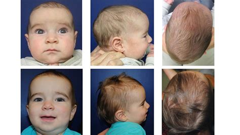 Craniosynostosis Surgery (2022)