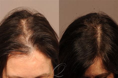 Quatela Center for Hair Restoration in Rochester for Buffalo & Syracuse, NY