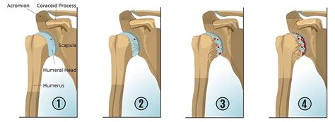 Shoulder Arthritis | Dr Raymond Yu