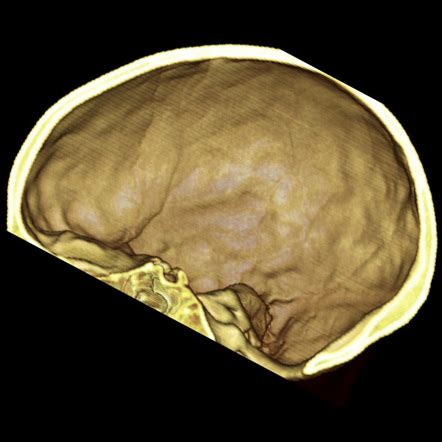 Convolutional markings | Radiology Reference Article | Radiopaedia.org