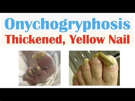 Onychogryphosis (Thickened, Yellow Nails) | Causes, Signs & Symptoms, Diagnosis, Treatment - YouTube