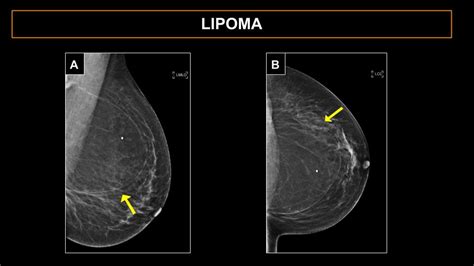 Breast Lipoma: Symptoms, Diagnosis and Treatment