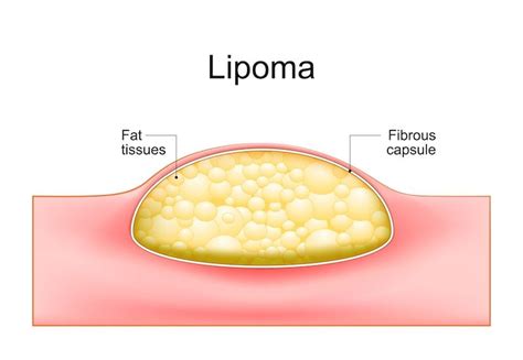 Lipoma