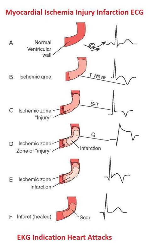 ECG of MI - MEDizzy