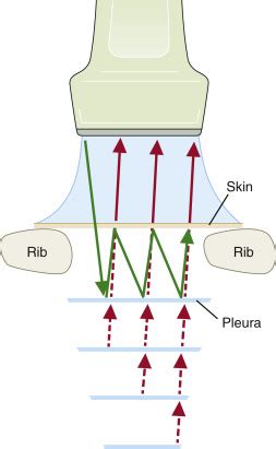 Imaging Artifacts | Radiology Key