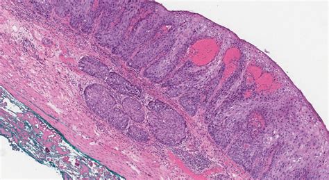 Squamous cell carcinoma of the esophagus | Ottawa Atlas of Pathology