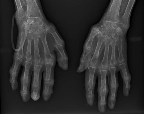 Coexisting Gout and Chondrocalcinosis on Hand Radiograph | The Journal ...