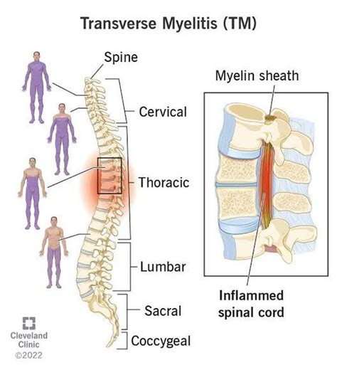 Transverse myelitis - MEDizzy