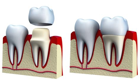 LAKE LANIER SMILES BLOG: ALL THINGS DENTAL CROWN: AN ARTICLE BY LAKE LANIER SMILES, BUFORD ...