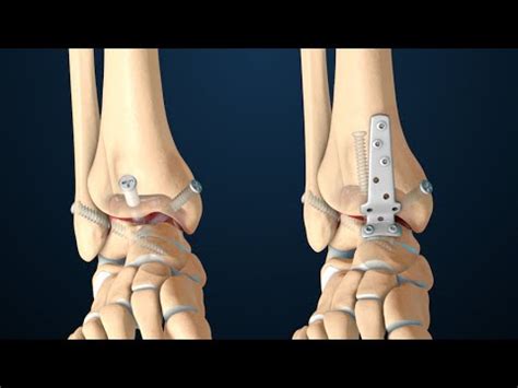 Arthrodesis | Anterior Ankle Fusion Surgery | Nucleus Health - YouTube