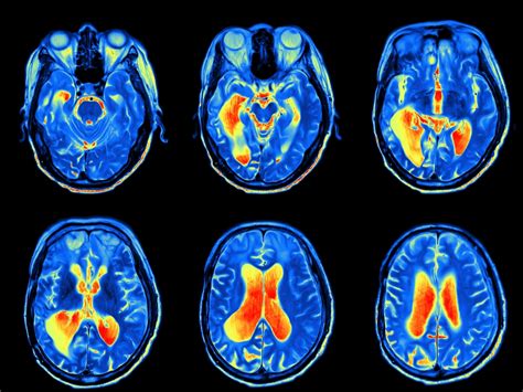 Neuroscience of Giftedness: Physiology of the Brain – Gro-Gifted