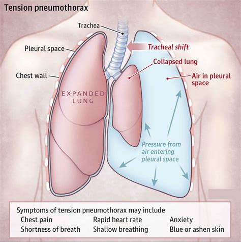 Hemothorax causes, signs, symptoms, diagnosis & hemothorax treatment