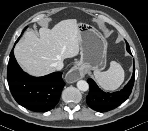 Large Hiatal Hernia - Esophagus Case Studies - CTisus CT Scanning