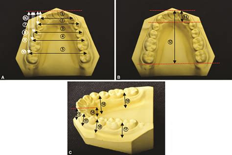 Analysis of the Facial Measurements and Dental Arch Dimensions for the ...