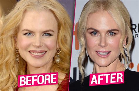 Nicole Kidman: Before And After Surgery - A Comprehensive Look