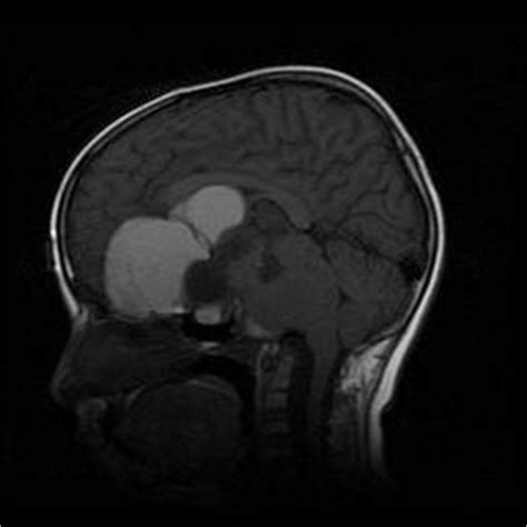 Craniopharyngioma-MRI - Sumer's Radiology Blog