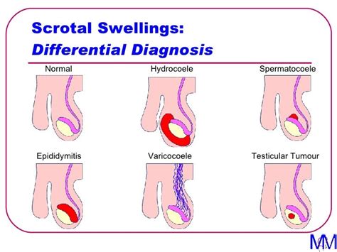 005 Scrotal Swellings - Introduction to Clinical Surgery Lectures