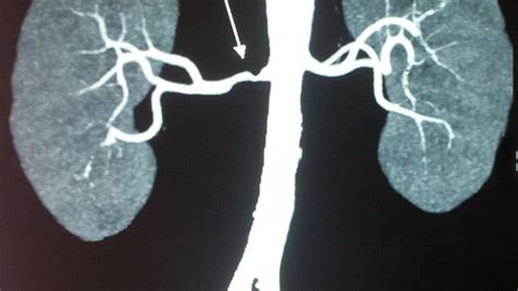 Azotemia – Definition, Development, Types, Diagnosis, Treatments | Drug Details