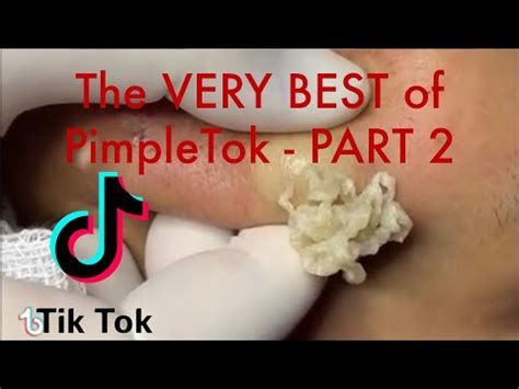 The BEST pimple, cyst and abscess pops of TikTok - Blackhead removal ...